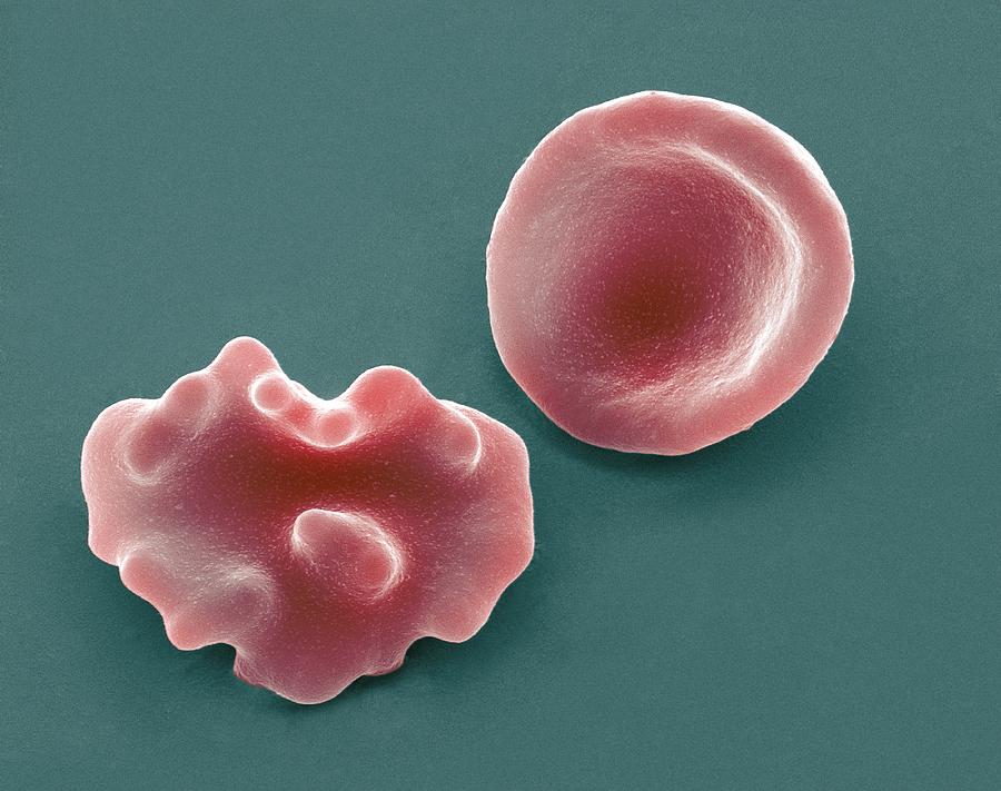 Abnormal Photograph - Healthy And Crenated Red Blood Cells, Sem #6 by Steve Gschmeissner