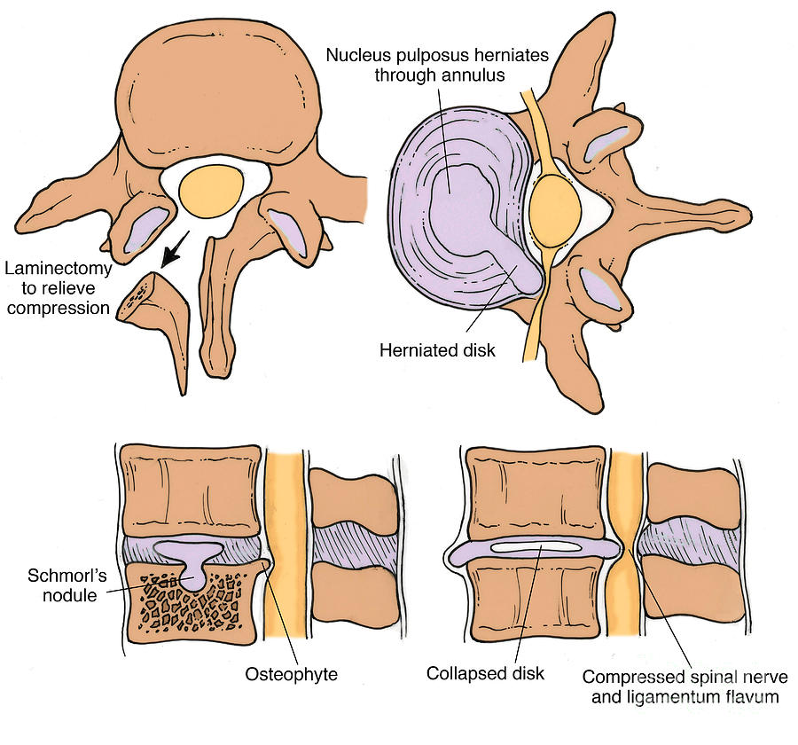 Illustration Of Spinal Disk Pathologies #6 Photograph by Science Source