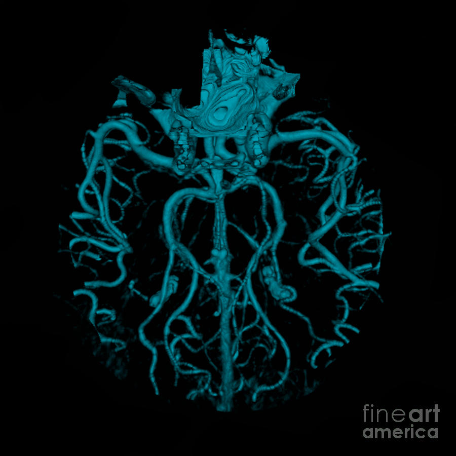 Intracranial Ct Angiogram #6  by Medical Body Scans