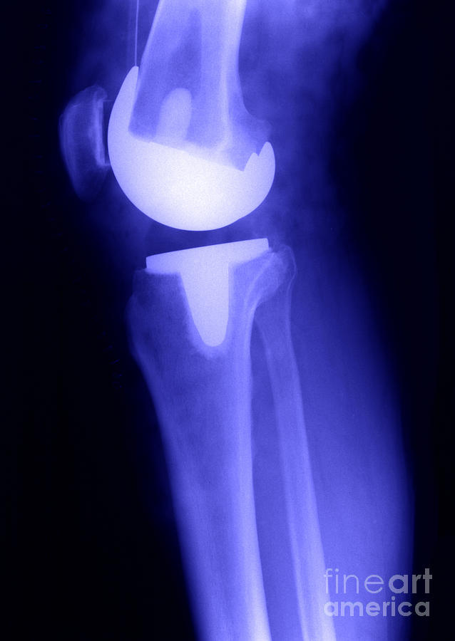 Knee Replacement X-ray #6 Photograph by Ted Kinsman