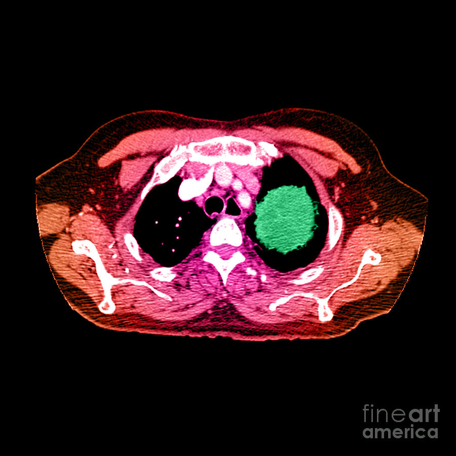 Lung Cancer #9 Photograph by Medical Body Scans