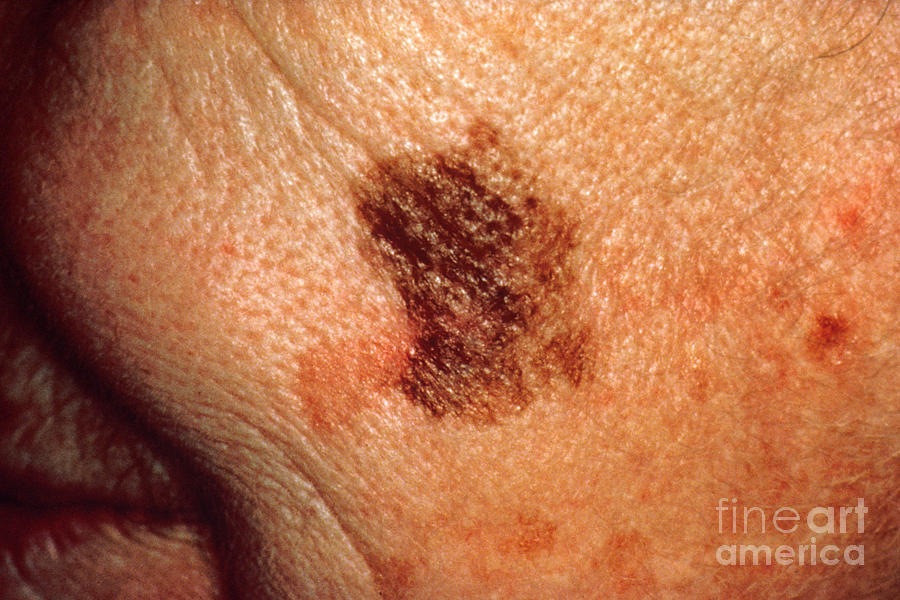 Melanoma #6 Photograph by Science Source Melanoma #6 Photograph by Science Source