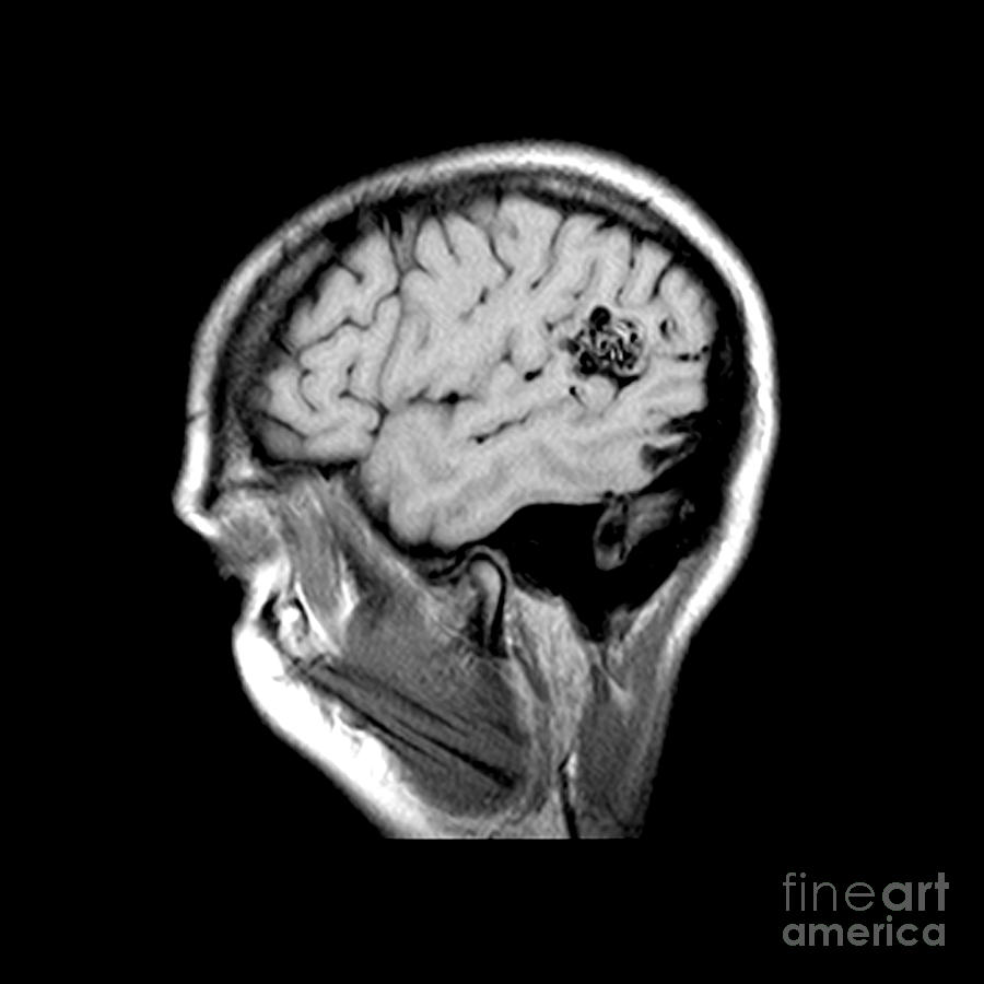 Mri Of Brain Avm #6 Photograph by Medical Body Scans