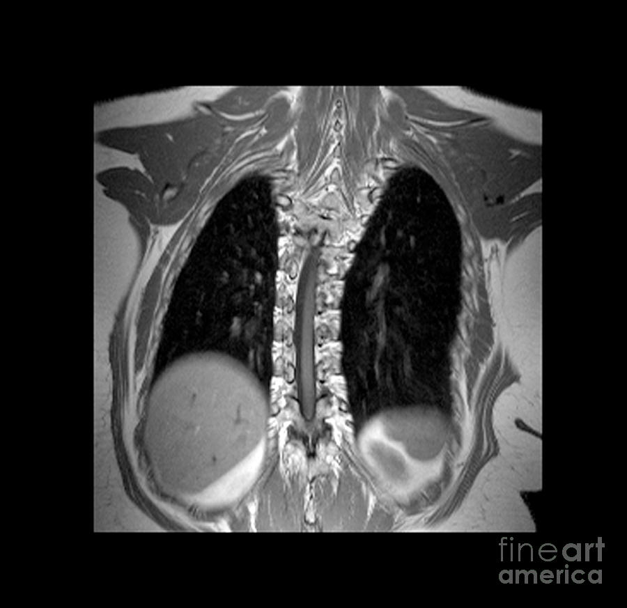 Mri Of Thoracic Scoliosis #6 Photograph by Medical Body Scans