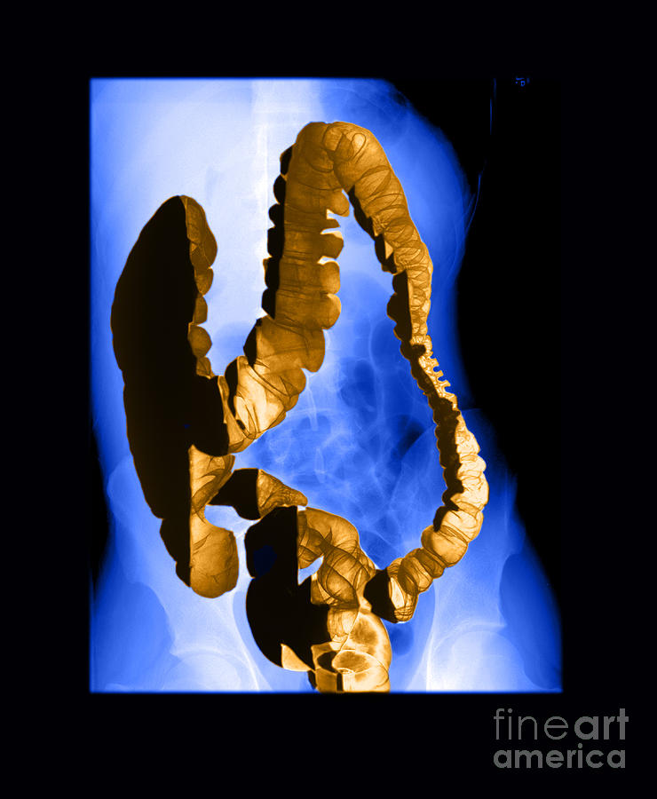 Normal Double Contrast Barium Enema #6 Photograph by Medical Body Scans