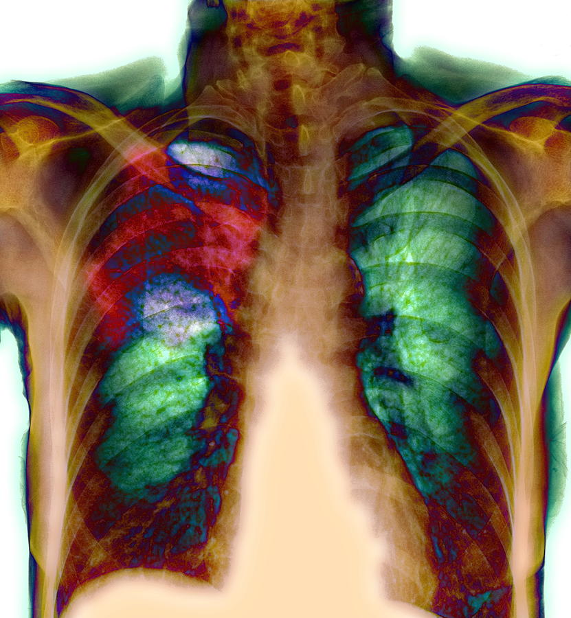 Pneumonia, X-ray #6 by Du Cane Medical Imaging Ltd