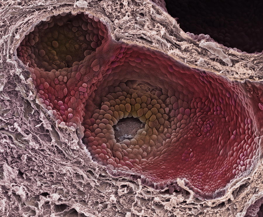 Prostate Cancer Sem Photograph By Steve Gschmeissner 2083