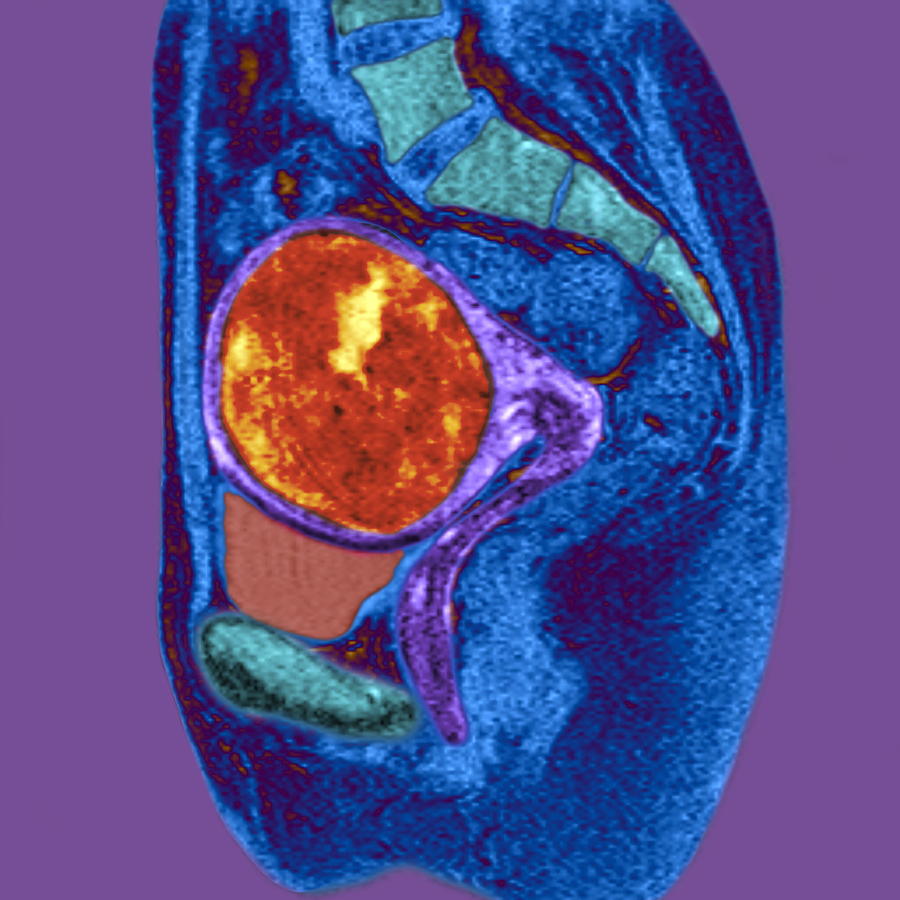 Fibroid Tumor Uterus