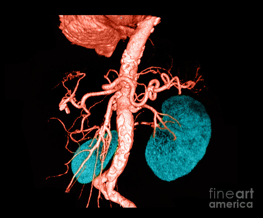 Abdominal Aorta #7 Photograph by Medical Body Scans