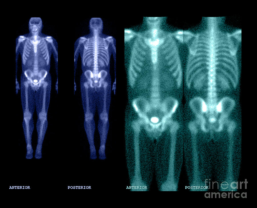 Skeleton Photograph - Bone Scan #7 by Medical Body Scans