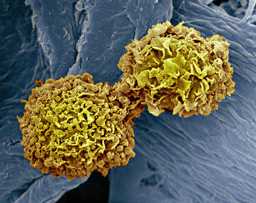 Breast Cancer Cells Sem Photograph By Steve Gschmeissner