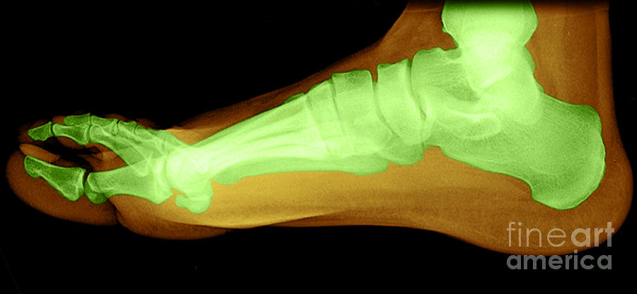 Flat Foot #7 Photograph by Medical Body Scans