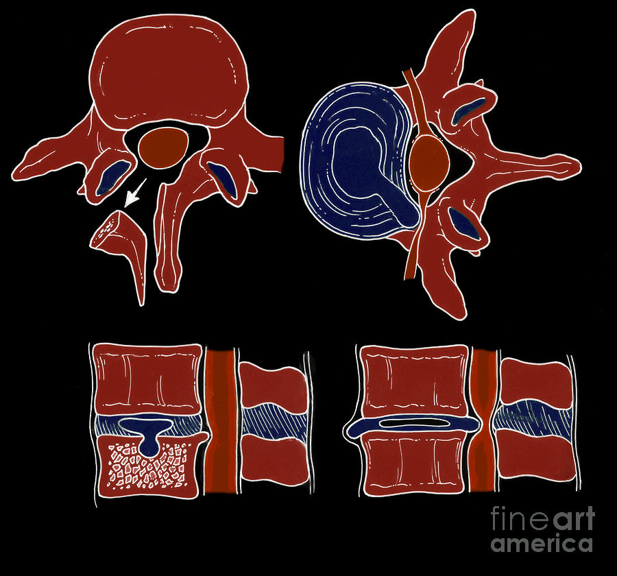 Illustration Of Spinal Disk Pathologies #7 Photograph by Science Source