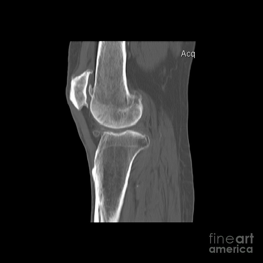 Knee Showing Osteoporosis #7 Photograph by Medical Body Scans