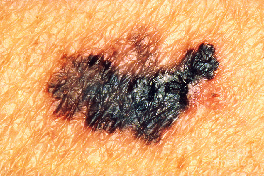 Melanoma #7 Photograph by Science Source