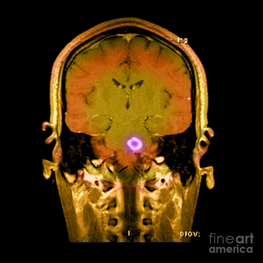 Mri Of Acute Ms #7  by Medical Body Scans