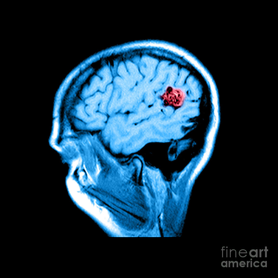 Mri Of Brain Avm #7 Photograph by Medical Body Scans