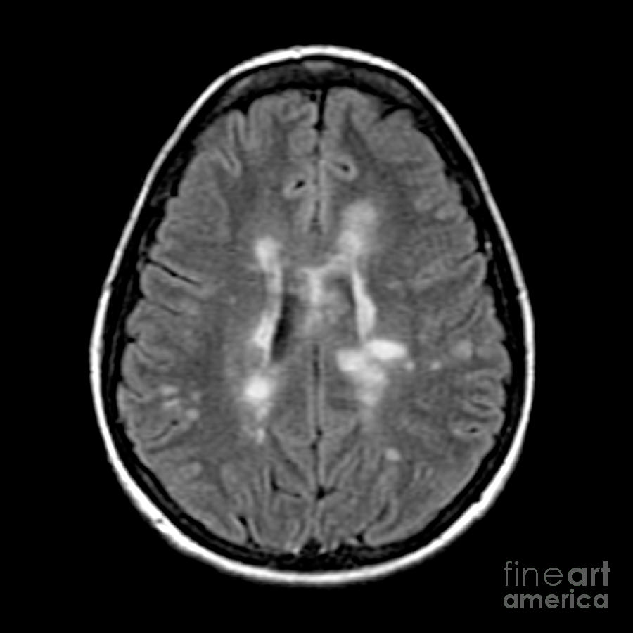 Mri Of Multiple Sclerosis #7 Photograph by Medical Body Scans