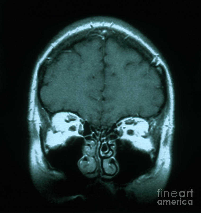 Mri Of Normal Brain #7 Photograph by Science Source