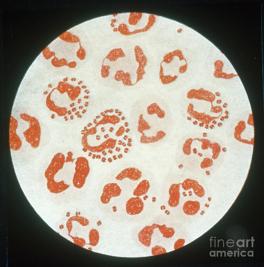 Pathology Photograph - Neisseria Gonorrhoeae #7 by Science Source