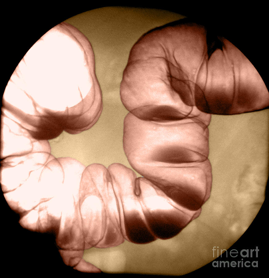 Intestine Photograph - Normal Double Contrast Barium Enema #7 by Medical Body Scans