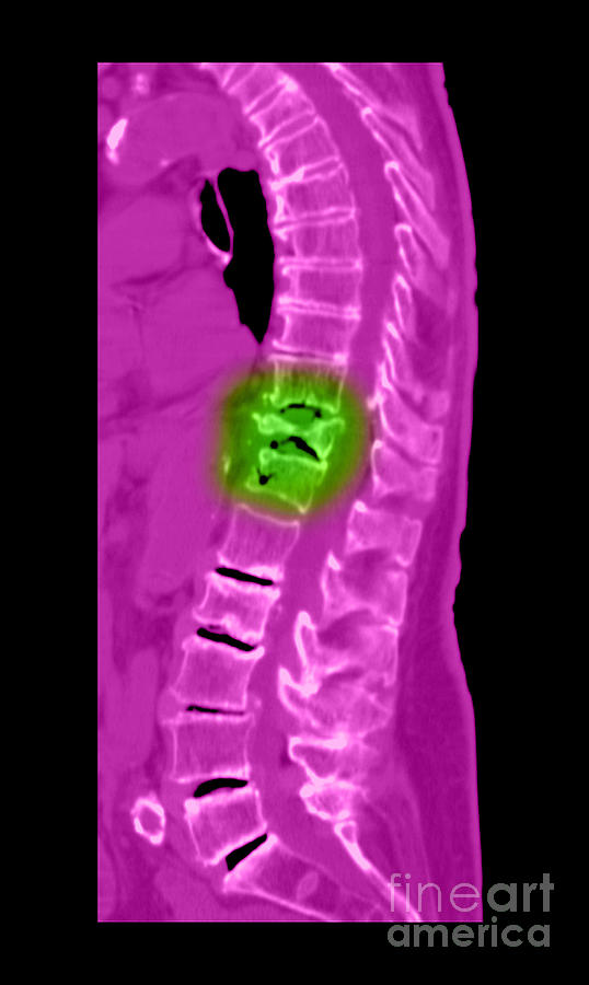 Severe Osteoporosis #7 Photograph by Medical Body Scans