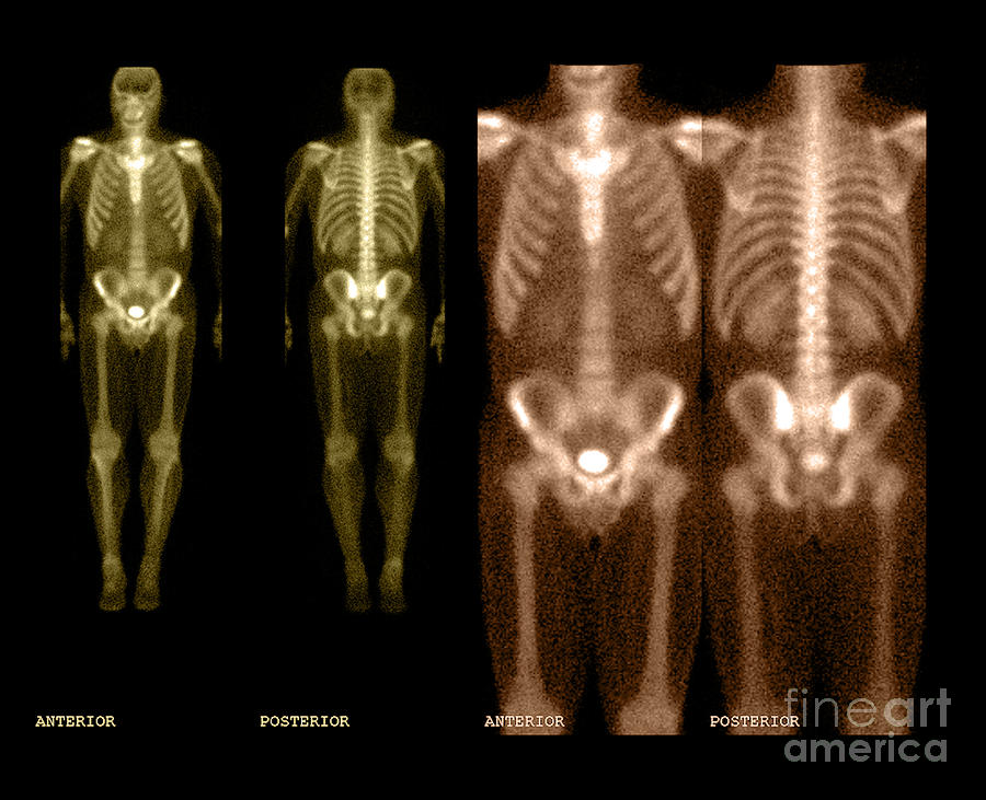 Bone Scan #8 Photograph by Medical Body Scans