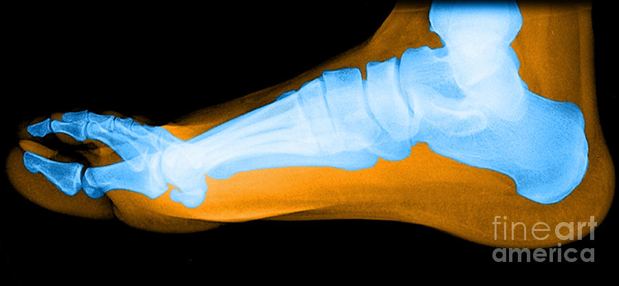Flat Foot #8 Photograph by Medical Body Scans