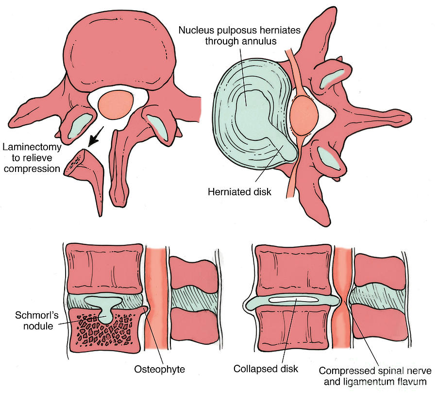 Illustration Of Spinal Disk Pathologies #8 Photograph by Science Source