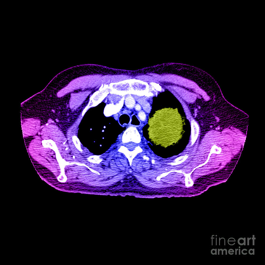 Lung Cancer #8 Photograph by Medical Body Scans