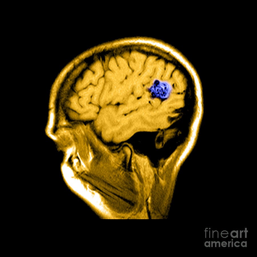 Abnormal Mri Brain Photograph - Mri Of Brain Avm #8 by Medical Body Scans