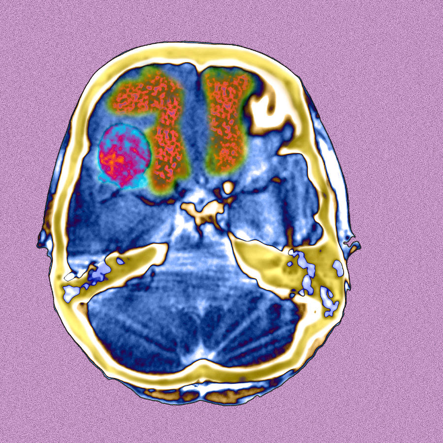 Secondary Brain Cancers, Ct Scan Photograph By Du Cane Medical Imaging ...