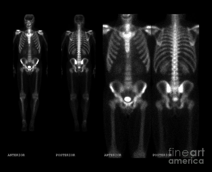 Bone Scan #9 Photograph by Medical Body Scans