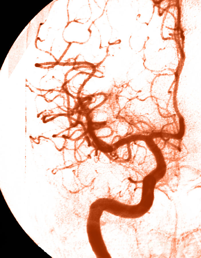 Cerebral Angiogram #9 Photograph by Medical Body Scans