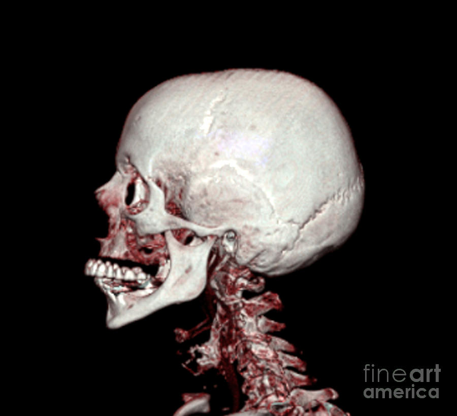 Human Skull #9 Photograph by Medical Body Scans