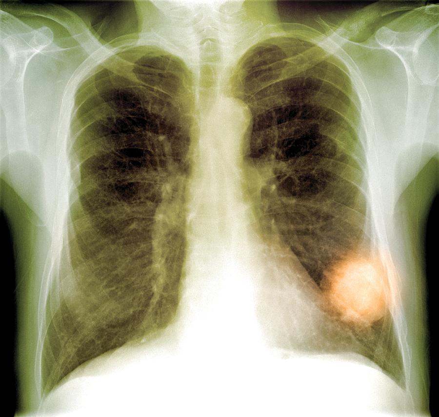 Lung Cancer, X-ray Photograph By Du Cane Medical Imaging Ltd - Pixels