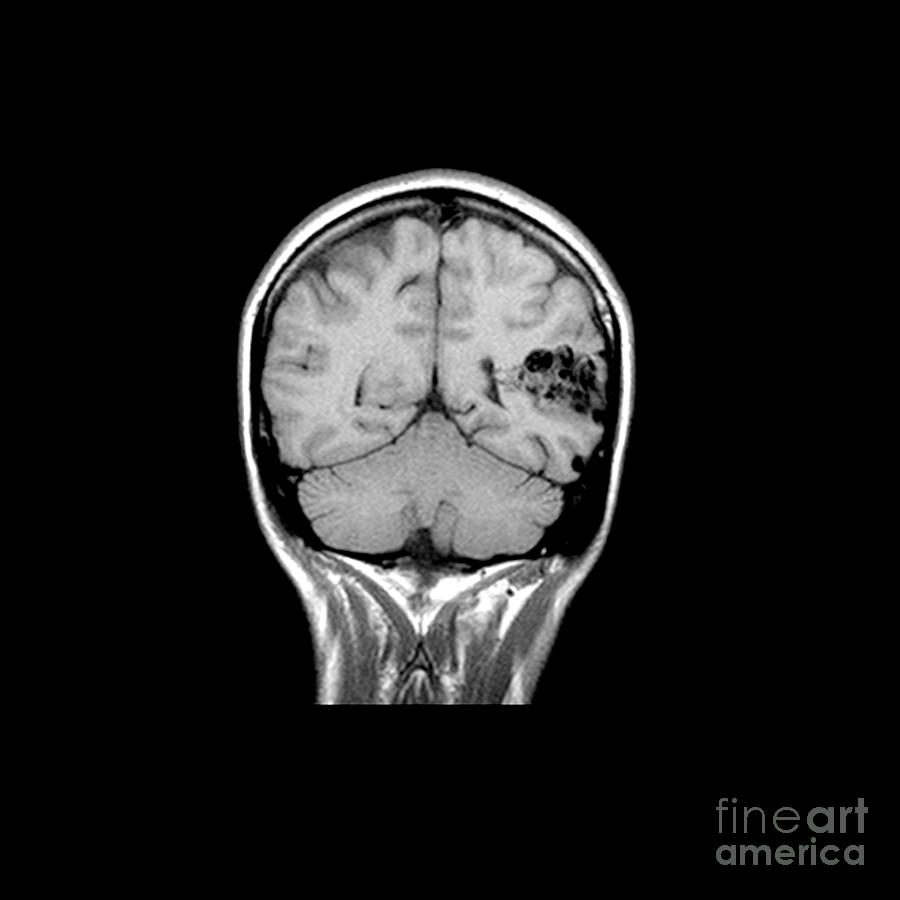 Mri Brain Photograph - Mri Of Brain Avm #9 by Medical Body Scans