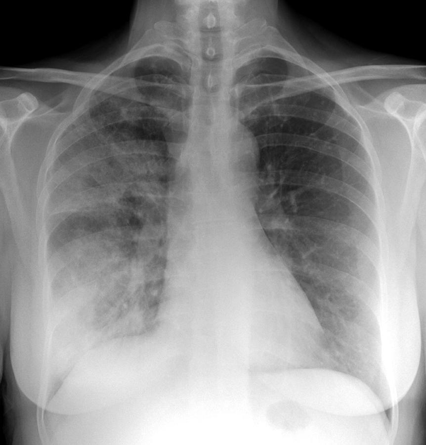 Pneumonia, X-ray #9 Photograph by Du Cane Medical Imaging Ltd - Fine ...