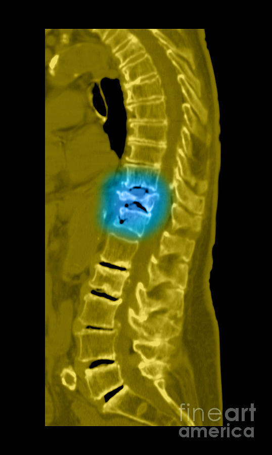 Severe Osteoporosis #9 Photograph by Medical Body Scans