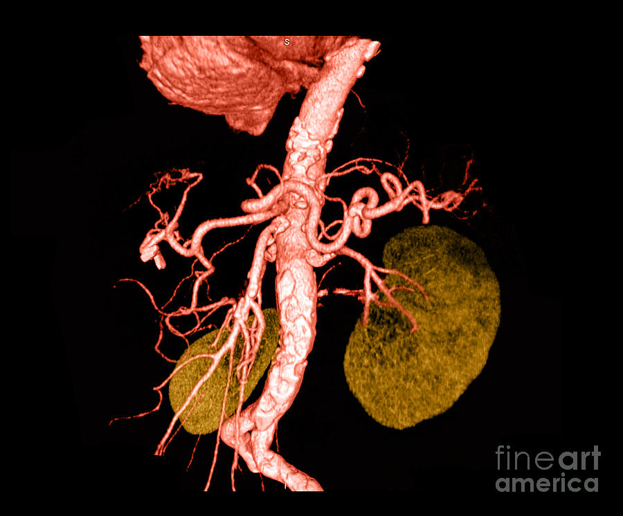Abdominal Aorta Photograph by Medical Body Scans