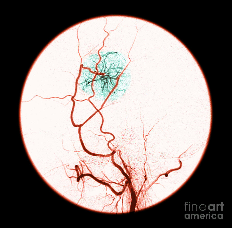 Abnormal Blood Flow Photograph by Medical Body Scans