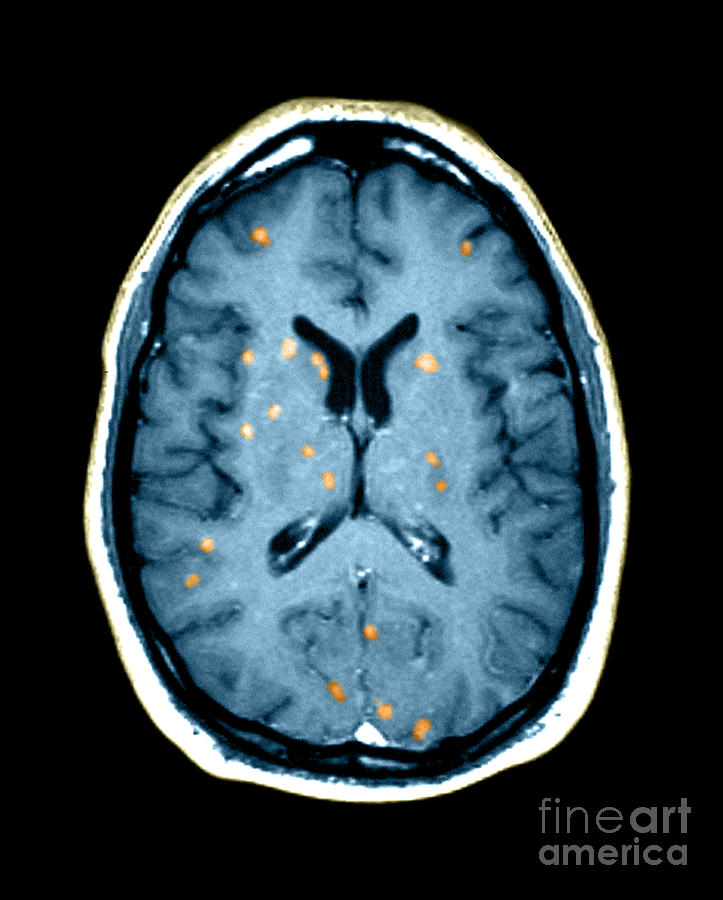 Medical Image Photograph - Abnormal Mri Of Brain by Medical Body Scans