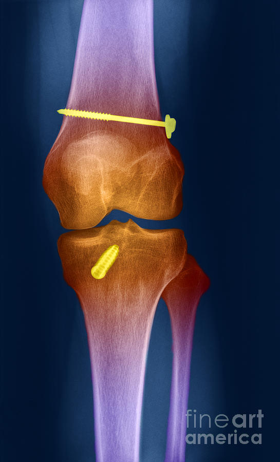 Acl Knee Repair X-ray Photograph by Ted Kinsman | Pixels