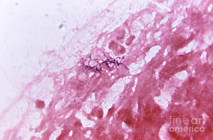 Actinomycosis Infection, Lm Photograph by Science Source