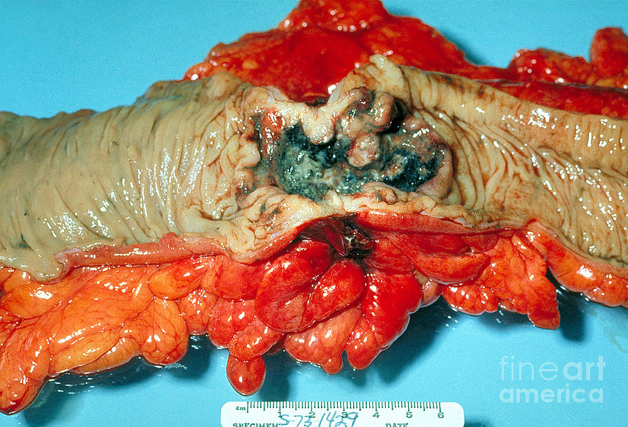Adenocarcinoma Photograph by Science Source