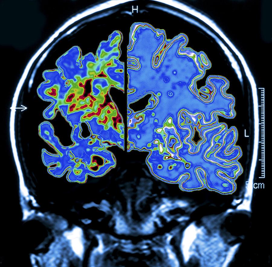 Alzheimer's Brain, Computer Artwork Photograph by Pasieka