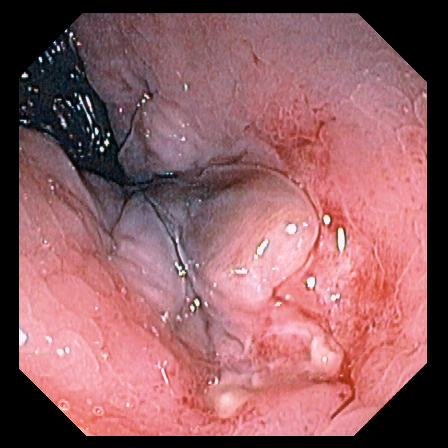 Anus Photograph - Anal Inflammation by David M. Martin, Md