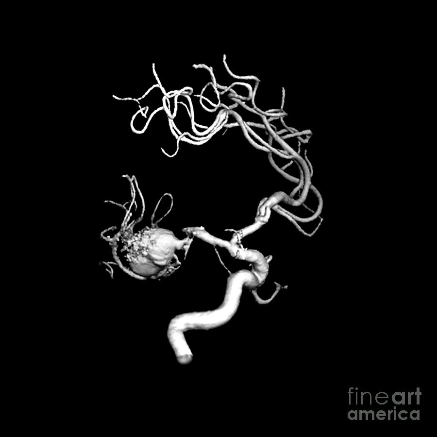 Aneurysm In The Human Brain Photograph by Medical Body Scans