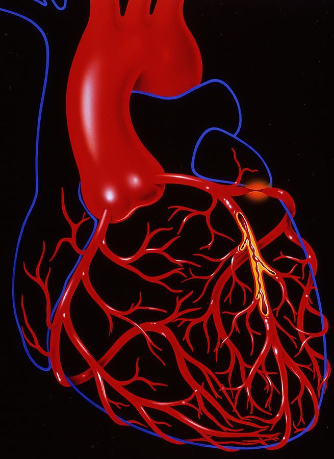 Angina Pectoris Photograph by John Bavosi - Fine Art America