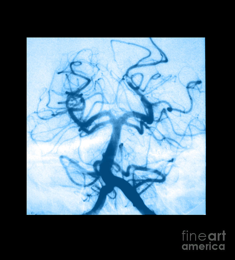 Angiogram Of Embolus In Cerebral Artery Photograph by Medical Body Scans